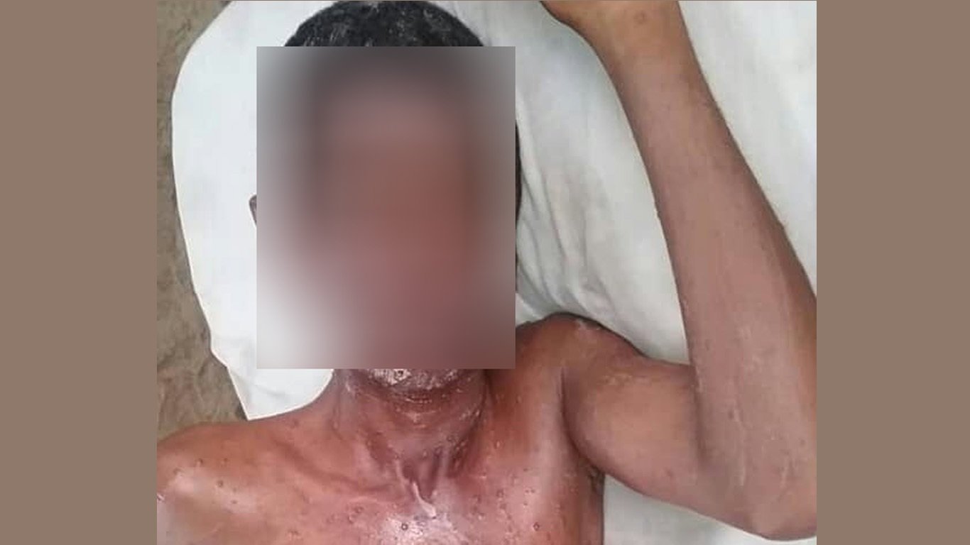 مرض "الجدري المائي" ينتشر مجدداً في صنعاء بعد عامين من الانحسار